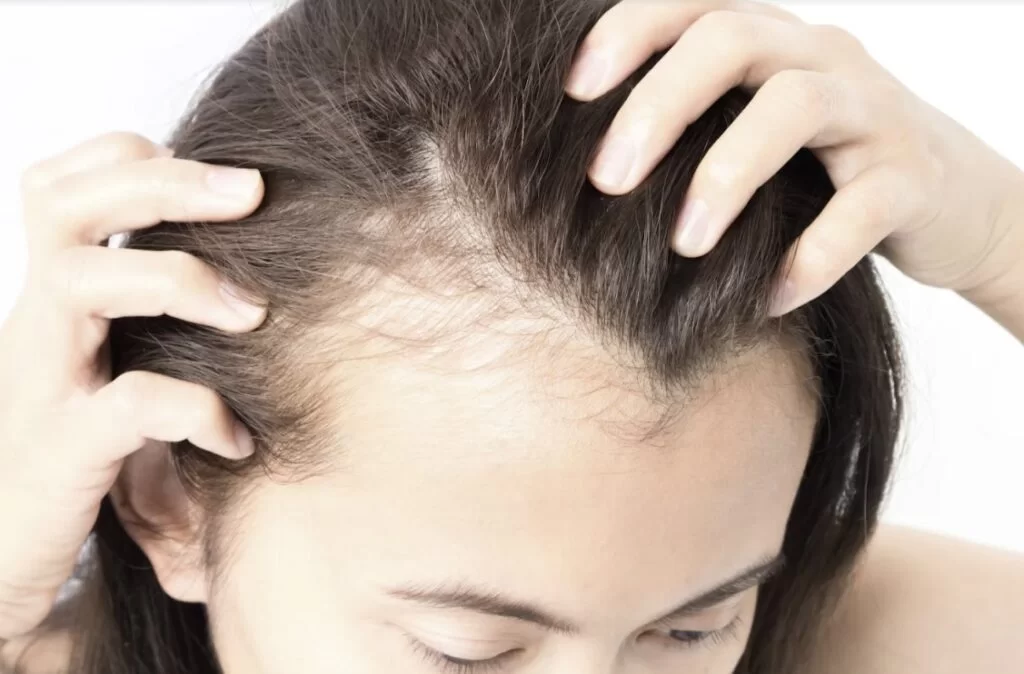 Chinese Herbs for Hair Loss: An Alternative Hair Loss Treatment in Singapore